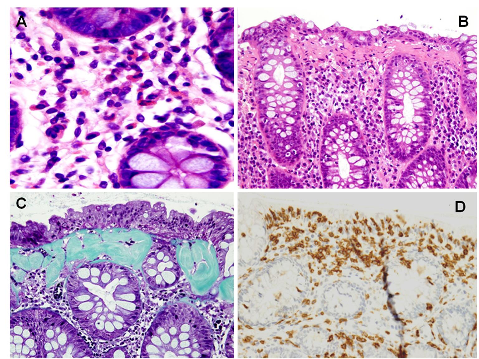 (PDF) Cherry-tree colon: colonoscopic appearance suggesting drug ...