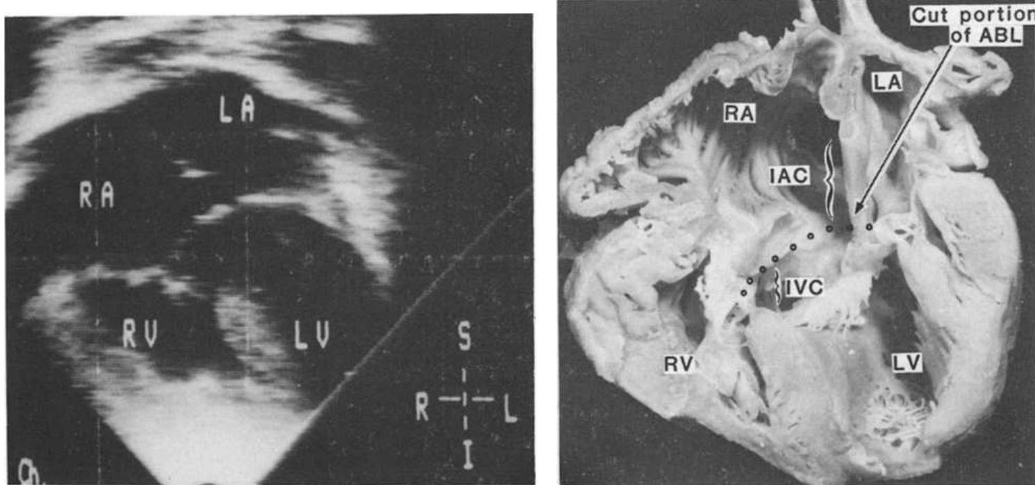 (PDF) Atrioventricular septal defects: cross-sectional ...