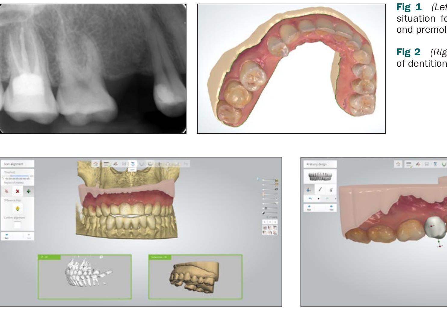 (PDF) In Vivo Accuracy of Implant Placement Using a Full Digital ...