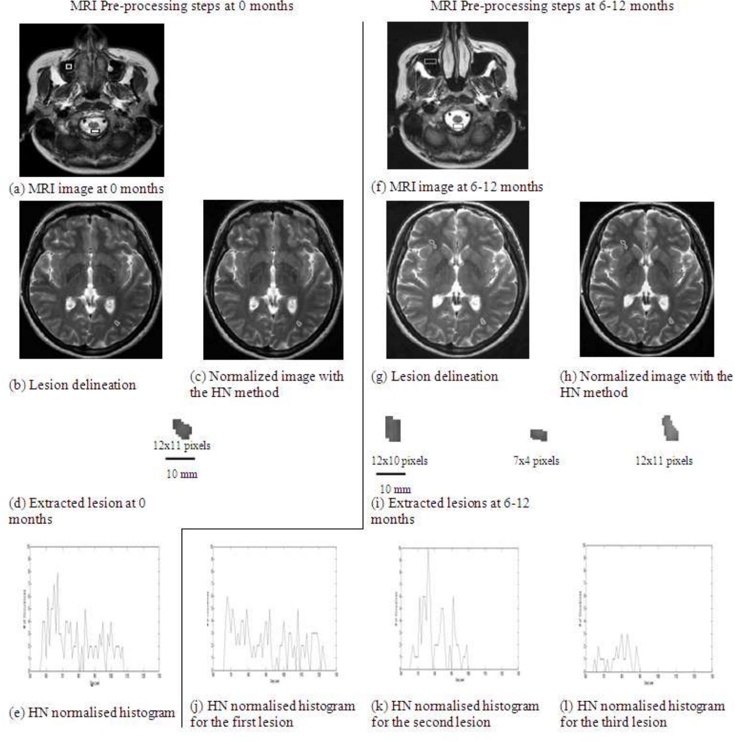 An example of mri preprocessing steps of a 34 year old