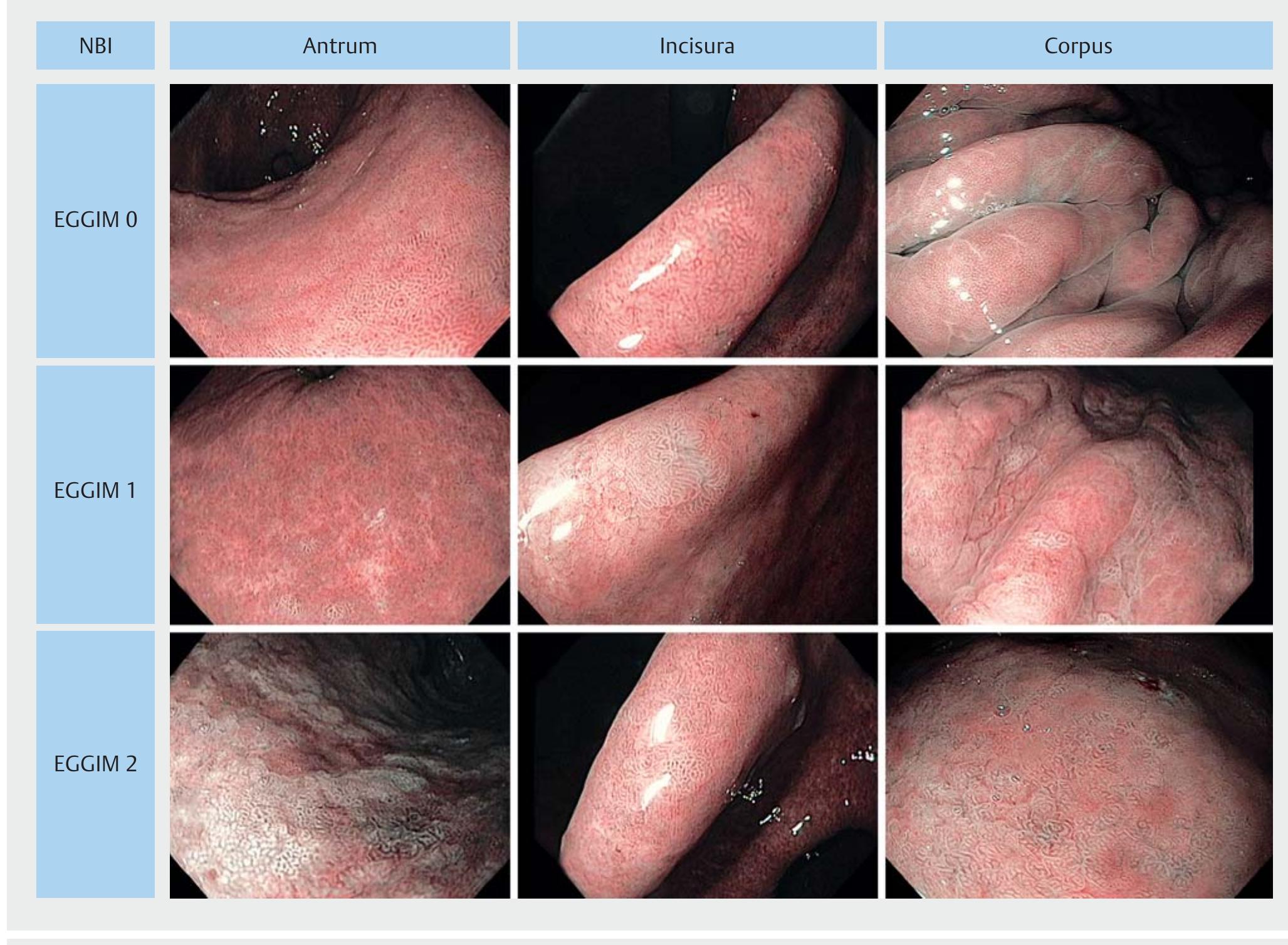 (PDF) Endoscopic grading of gastric intestinal metaplasia (EGGIM): a ...