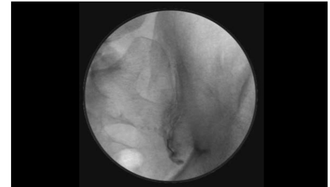 (PDF) Sacroiliac Joint as a Pain Generator in Patients With Lumbar Disc ...