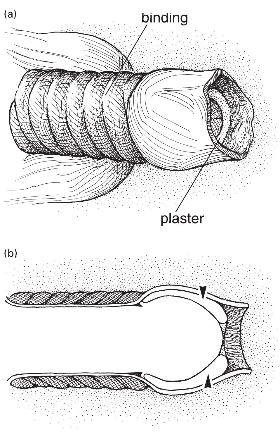 Subcoronal Incision (PDF) Surgical methods of restoring the prepuce: a critical review