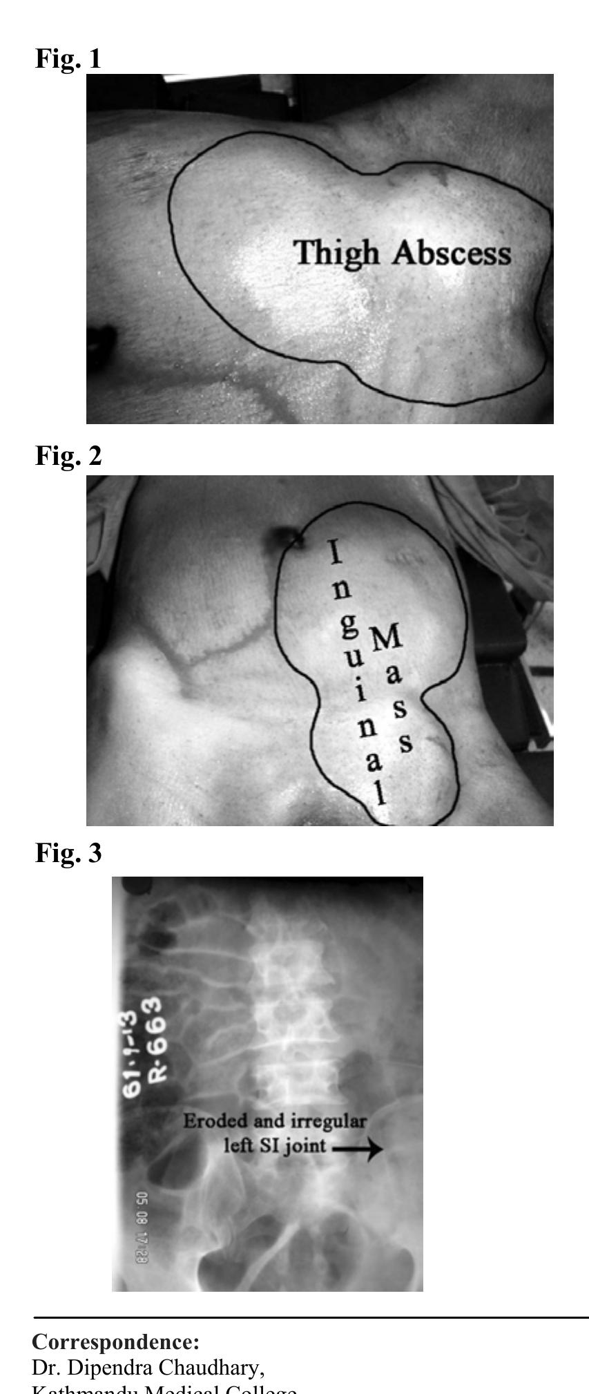 (PDF) Intra abdominal abscess presenting as a thigh abscess