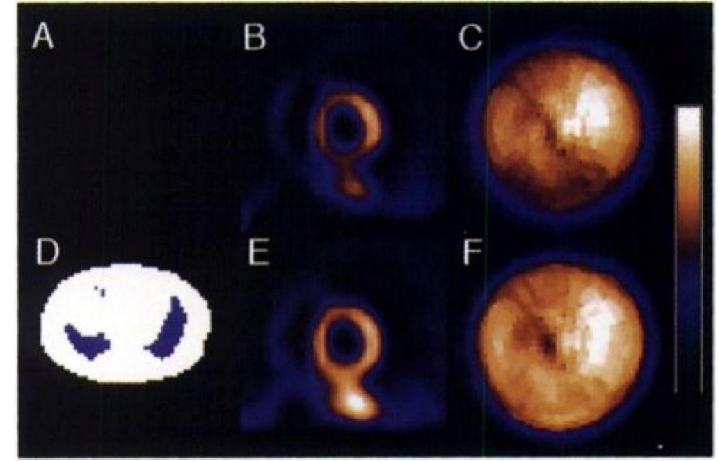 (PDF) Attenuation correction in cardiac SPECT without a transmission ...