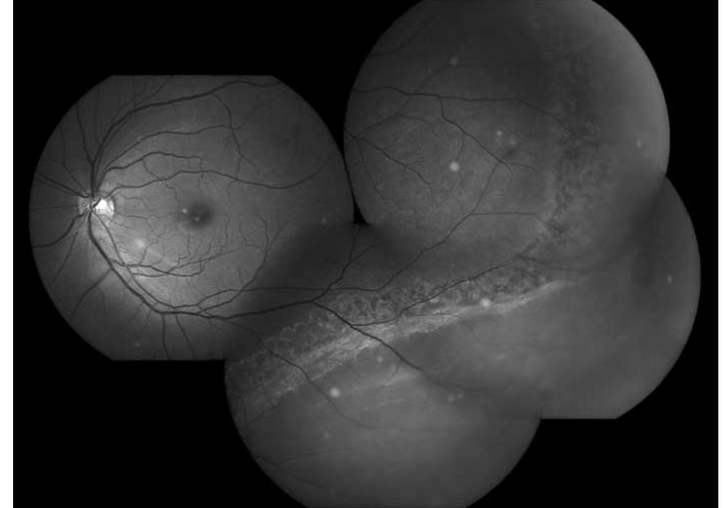 Retinal Undulation (PDF) Barrage laser photocoagulation for macula-sparing asymptomatic ...