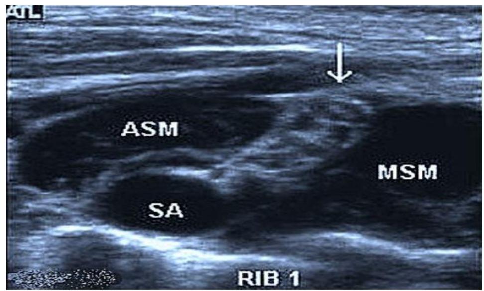 - asm; msm, anterior and middle scalene muscles; (sa) the