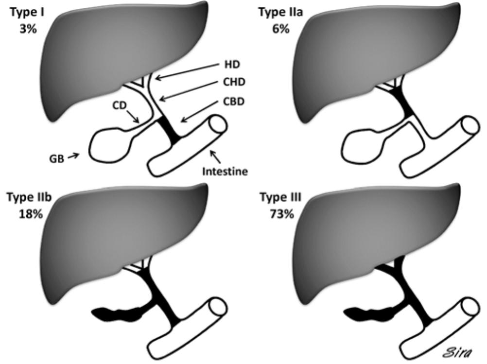 Schematic illustration of biliary atresia classification.
