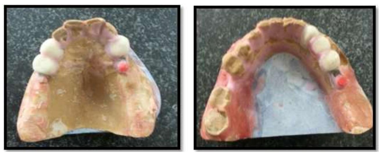 Figure 4 - from Cast Partial Denture Retained Using