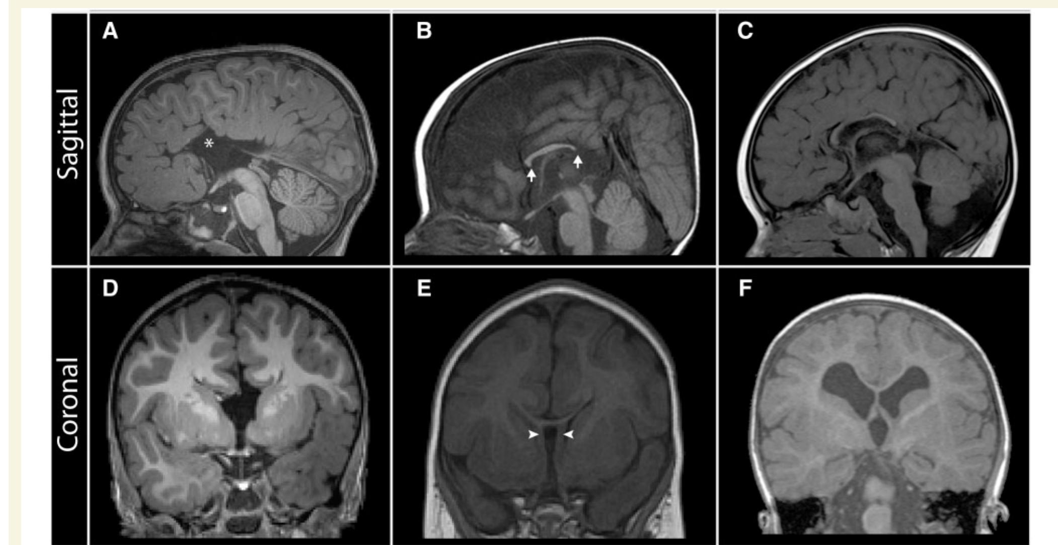 Navicular Cortex Mri Figure 1 - from Clinical, genetic and imaging findings