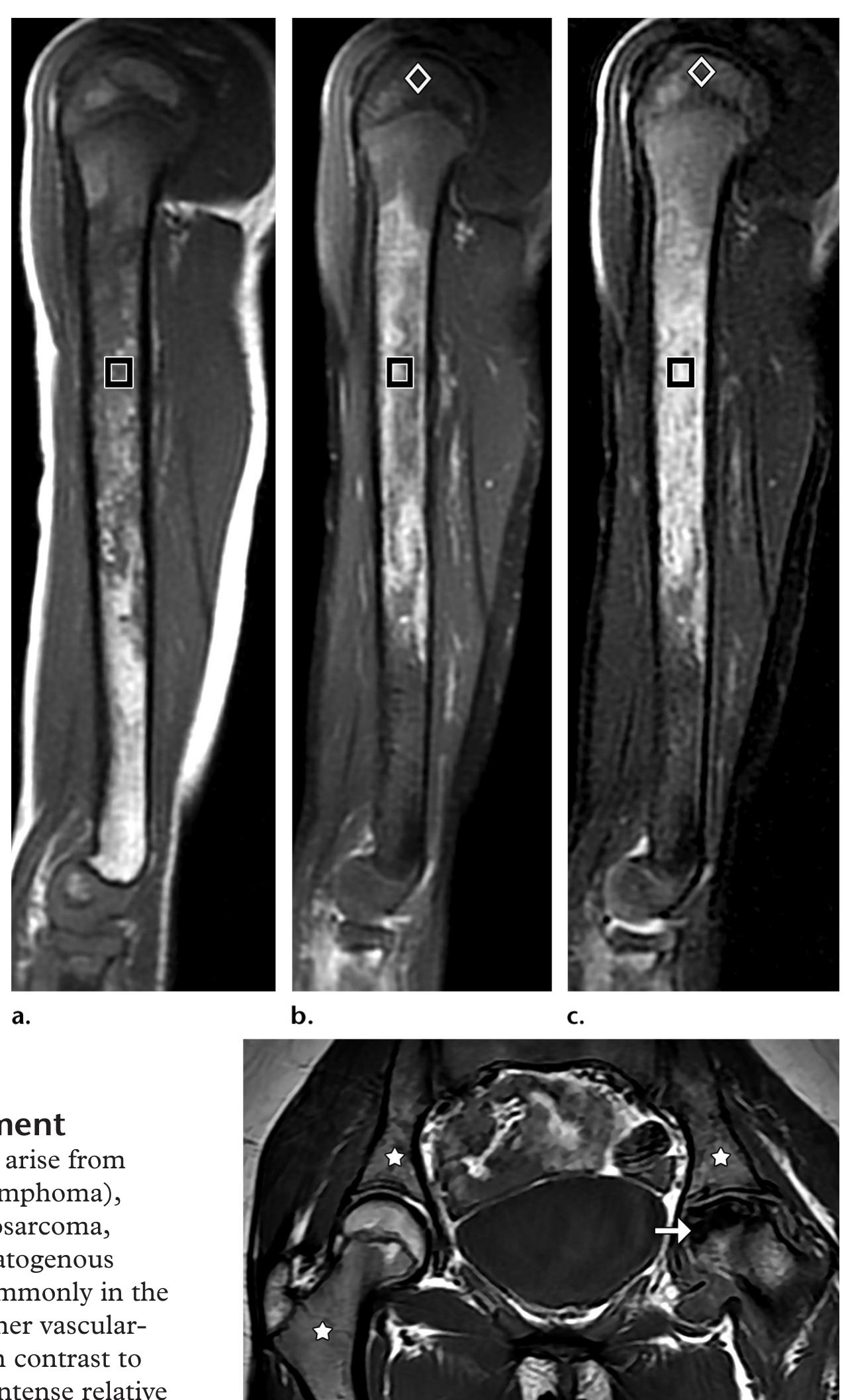 Marrow Conversion Pattern (PDF) MR Imaging of Pediatric Bone Marrow