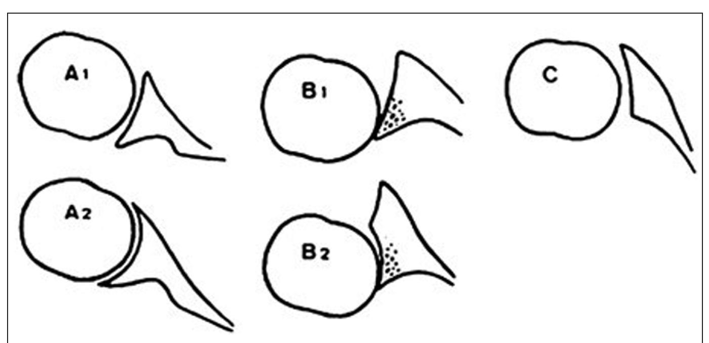 Figure 1 - from Challenges in Reverse Shoulder Arthroplasty: