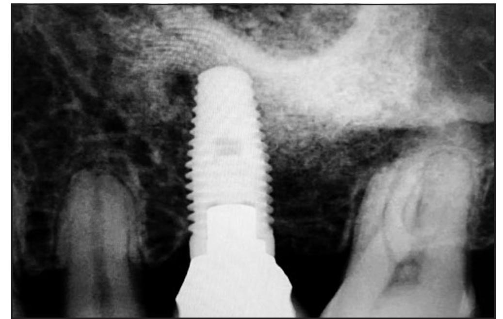 Figure 12 - from A Less-Invasive Window Design for Lateral