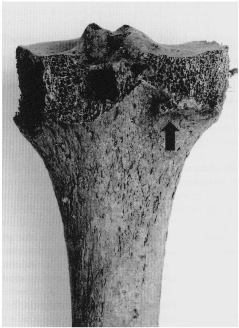 Marginal lipping on the superior fibular articular facet on