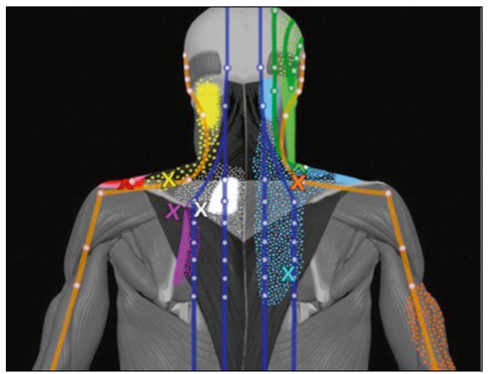Figure 1 - from Trigger Points and Classical Acupuncture
