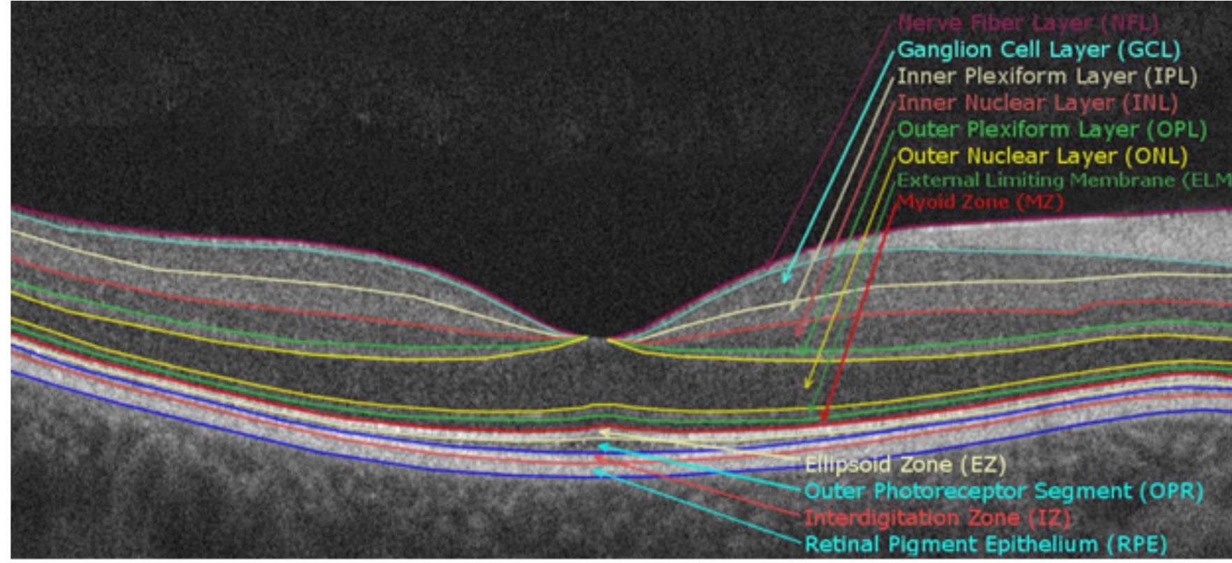 (PDF) Classification of retinal diseases based on OCT Images