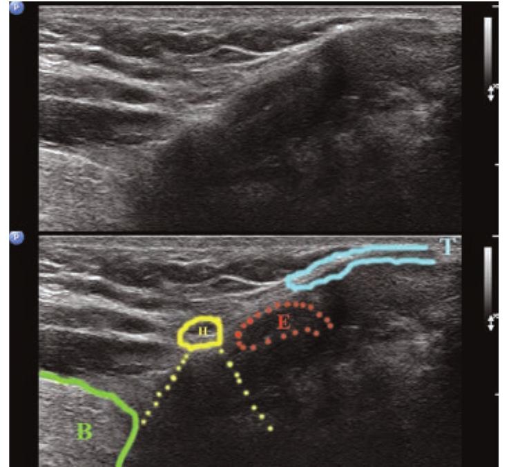 (PDF) Ultrasonographic anatomy of head and neck - a pictorial for the ...