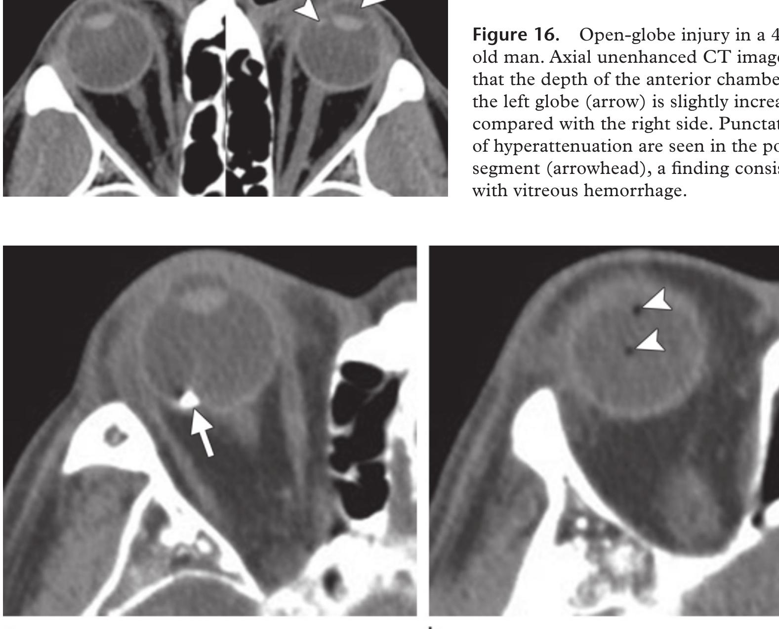 (PDF) Injuries of the Globe: What Can the Radiologist Offer?