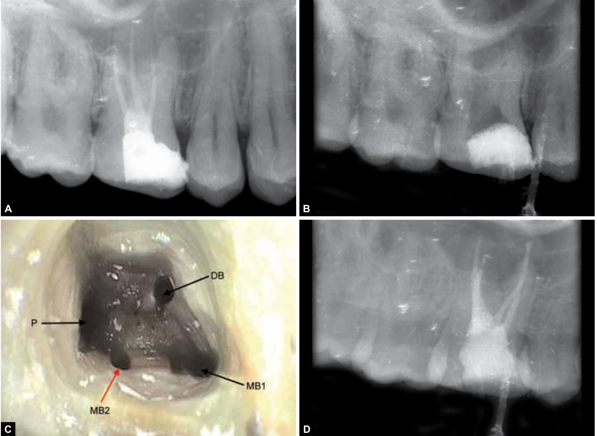 S 1a to d: (a) preoperative radiograph, (b) intraoral