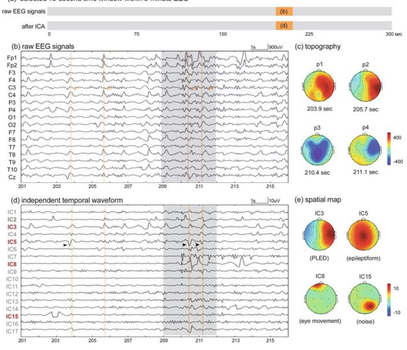 PDF) Blind Source Separation of Concurrent Disease-Related