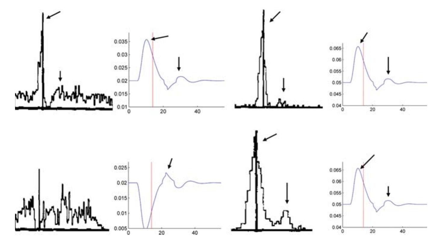 PDF) Blind Source Separation of Concurrent Disease-Related