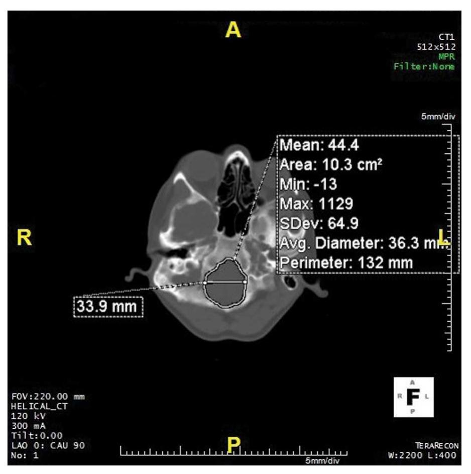 Figure 2 - from Sex determination from the foramen magnum