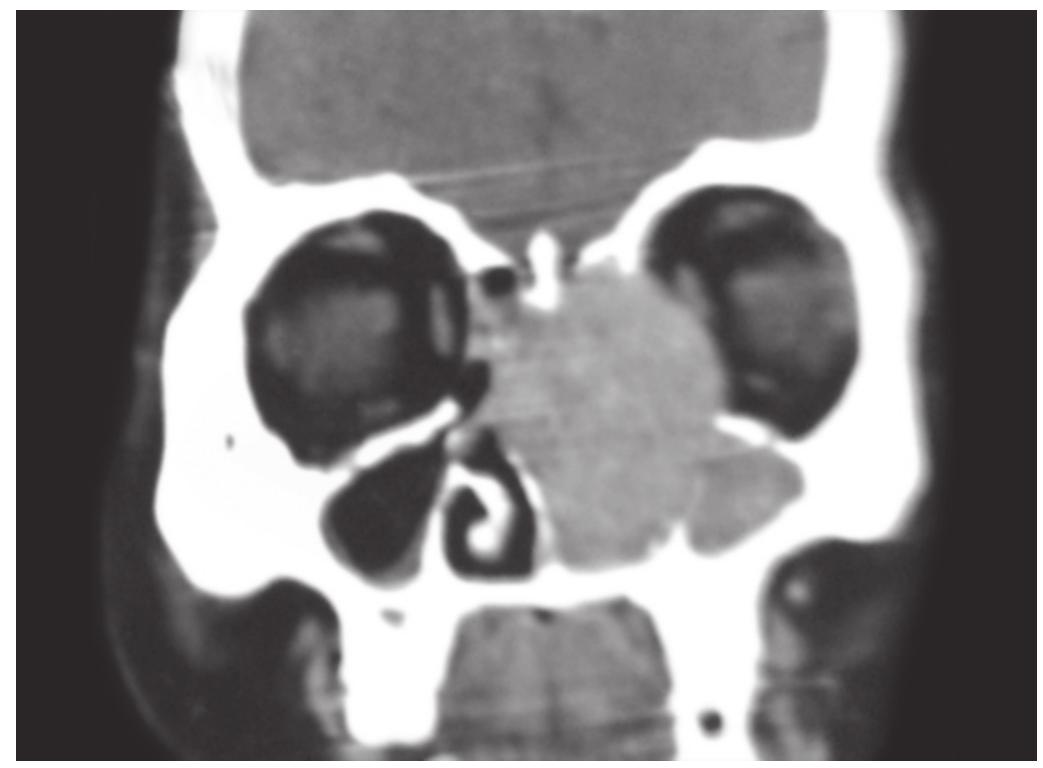 (PDF) Extramedullary Plasmacytoma of Nasal Cavity