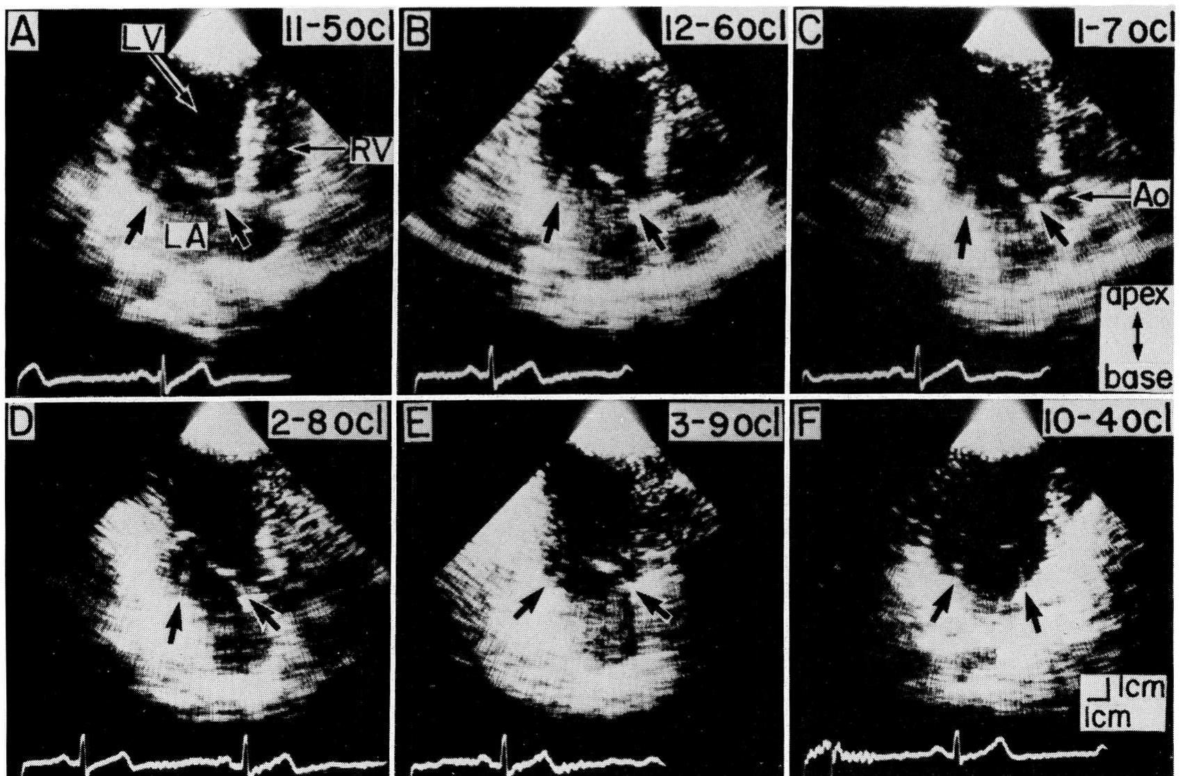(PDF) Size and motion of the mitral valve annulus in man. I. A two ...