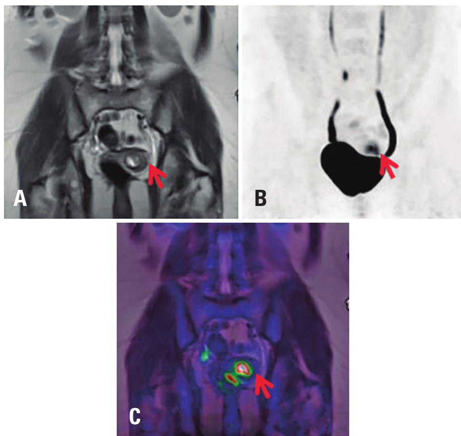 '°f-fdg pet/mri images of a female pelvis with invasive