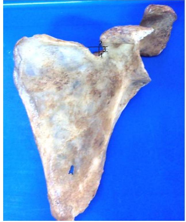 (PDF) Morphometric Study of Suprascapular Notch as a Factor of ...