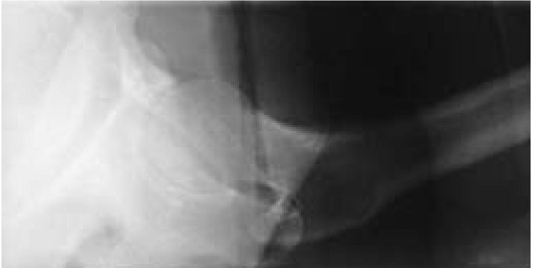 (PDF) Horizontal beam lateral view of the hip