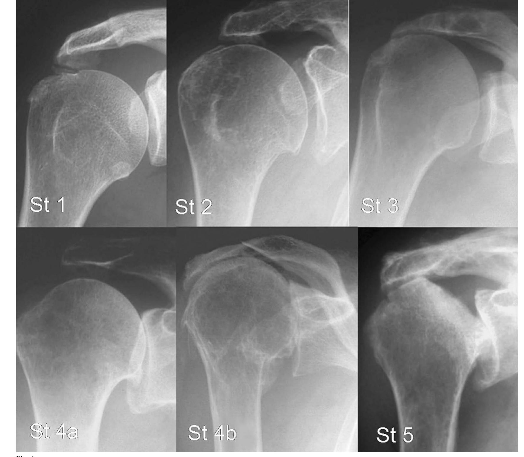 (PDF) Reverse Total Shoulder Arthroplasty: A Review of Results ...