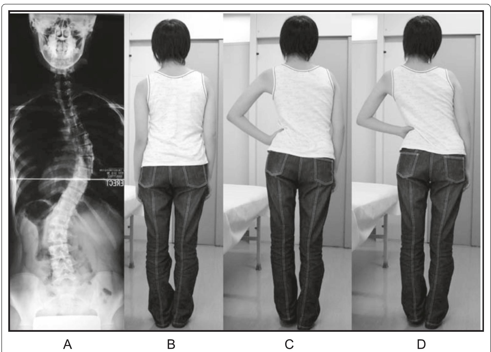 Side Shift Method (PDF) Physiotherapy scoliosis-specific exercises - a comprehensive ...
