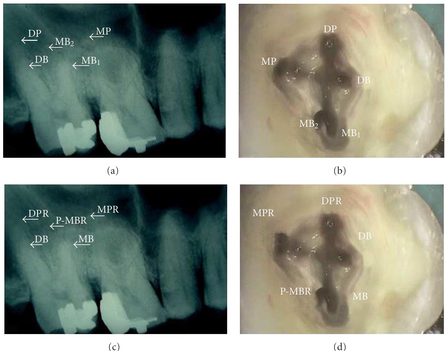Stout Roots Radiograph Ficure 4: (a) radiograph showing the root morphology of five