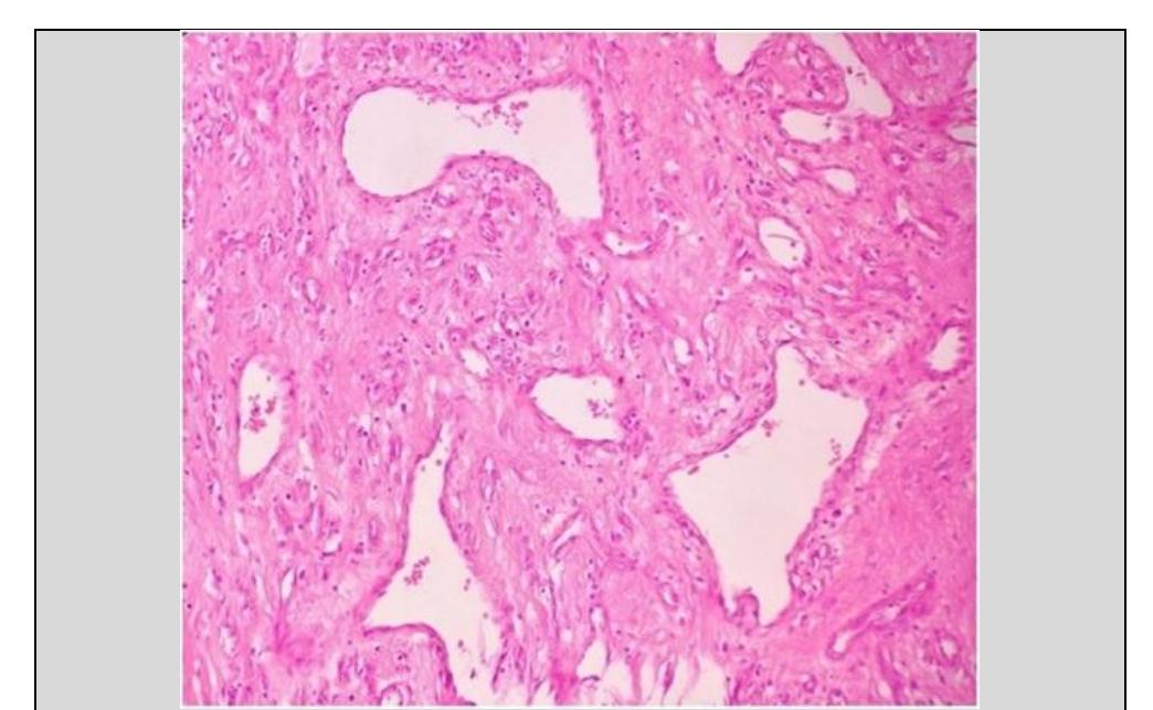 A histopathology picture of nasal cavity showing mixed