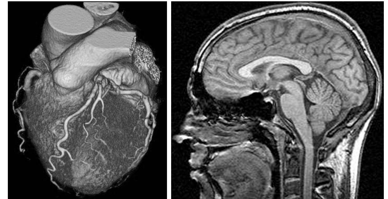 Left: volume rendering of a human heart acquired using