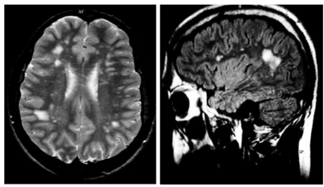 Fic. 3. axial and sagittal t2-weighted brain magnetic