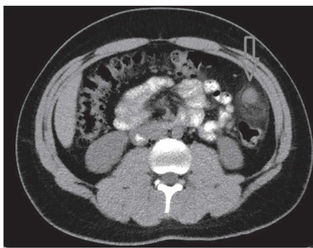 [1545] abdominal ct scan: a hypodense, homogeneous mass with