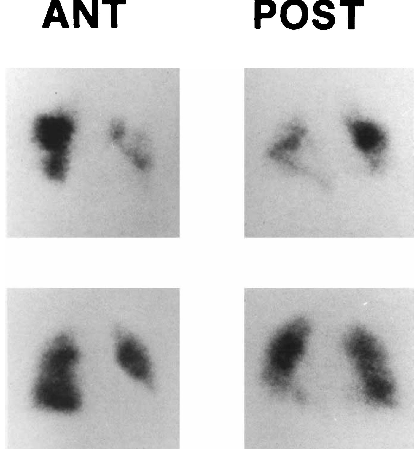 Anterior and posterior views of perfusion lung scans in a