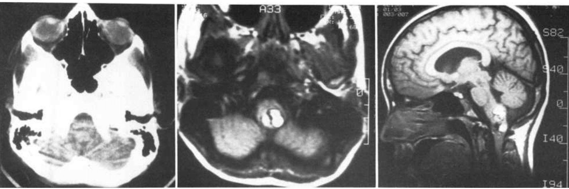 Fic. 1. case7. left: computerized tomography scan with