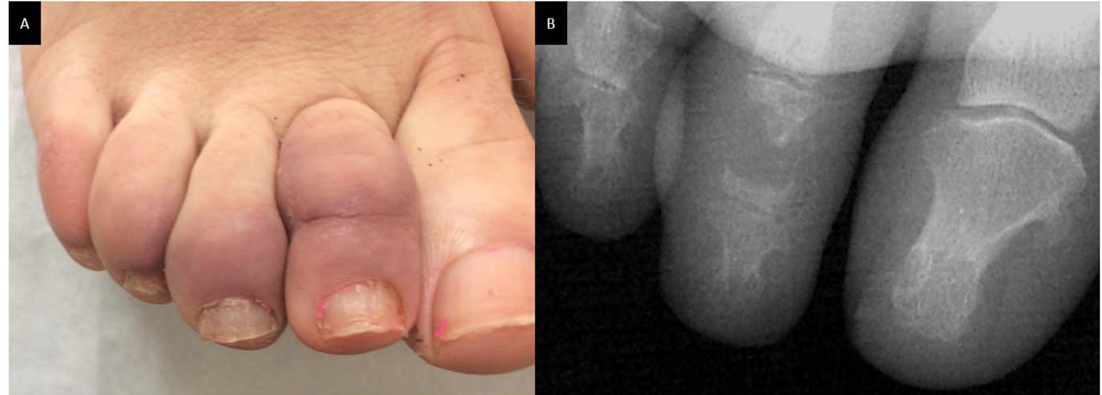 (PDF) Sarcoidosis: A Clinical Overview from Symptoms to Diagnosis