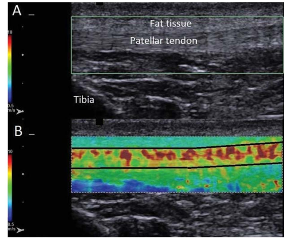 (PDF) Shear Wave Elastography Is a Reliable and Repeatable Method for ...