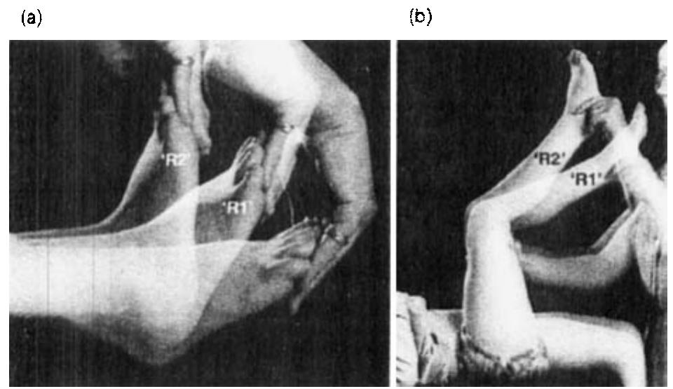 Hamstring Length R1 And R2 (PDF) Objective measurement of clinical findings in the use of ...
