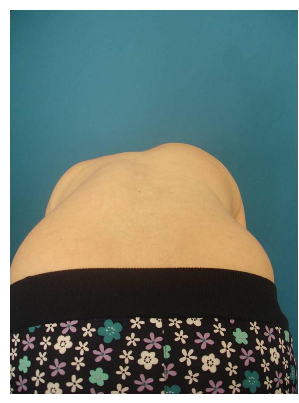 Trunk rotation measurement by using a scoliometer