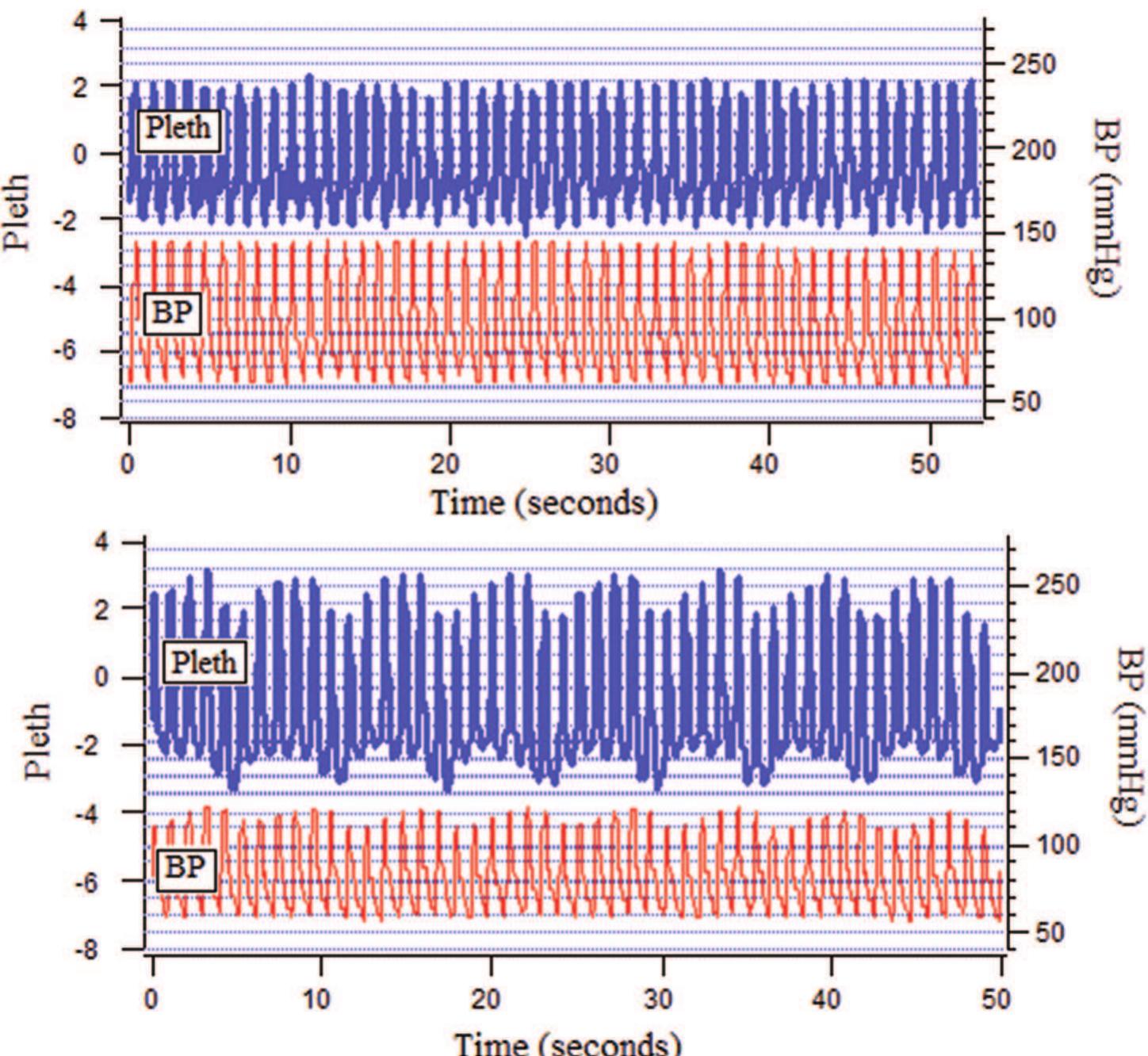 (PDF) Photoplethysmography: beyond the calculation of arterial oxygen ...