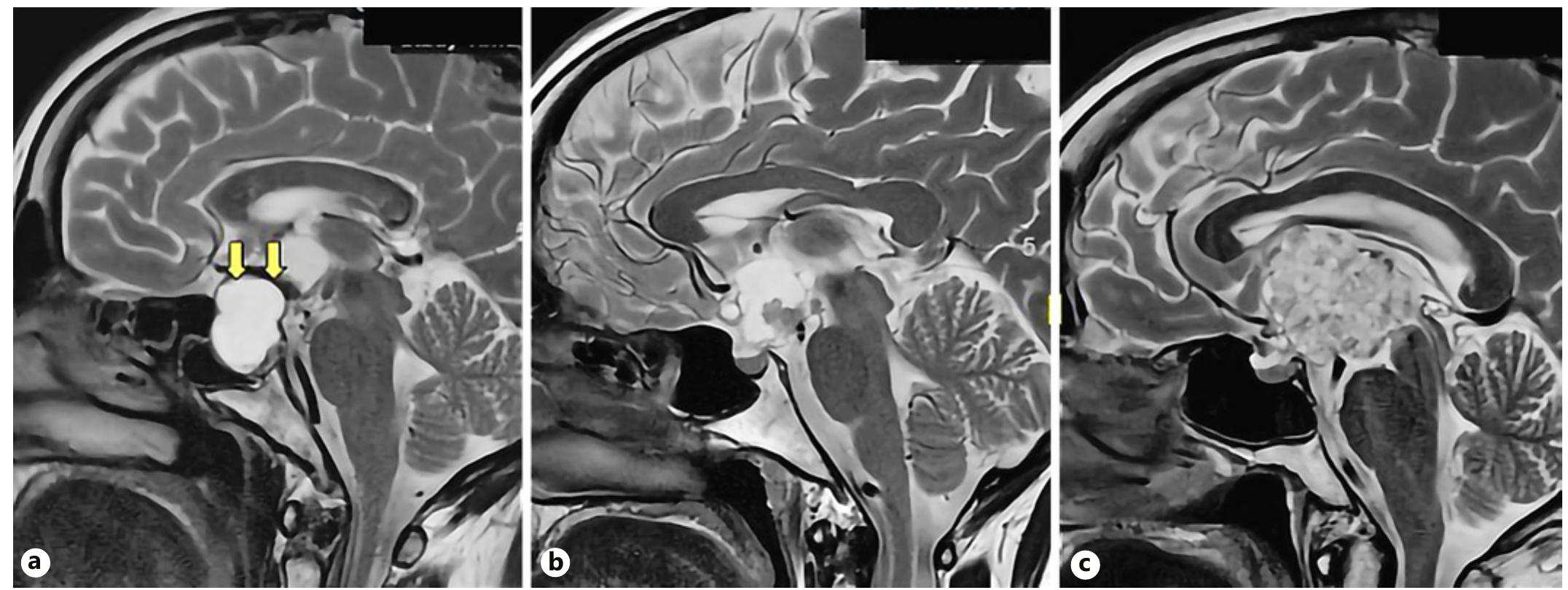 Figure 6 - from Diagnosis and Treatment of Parasellar