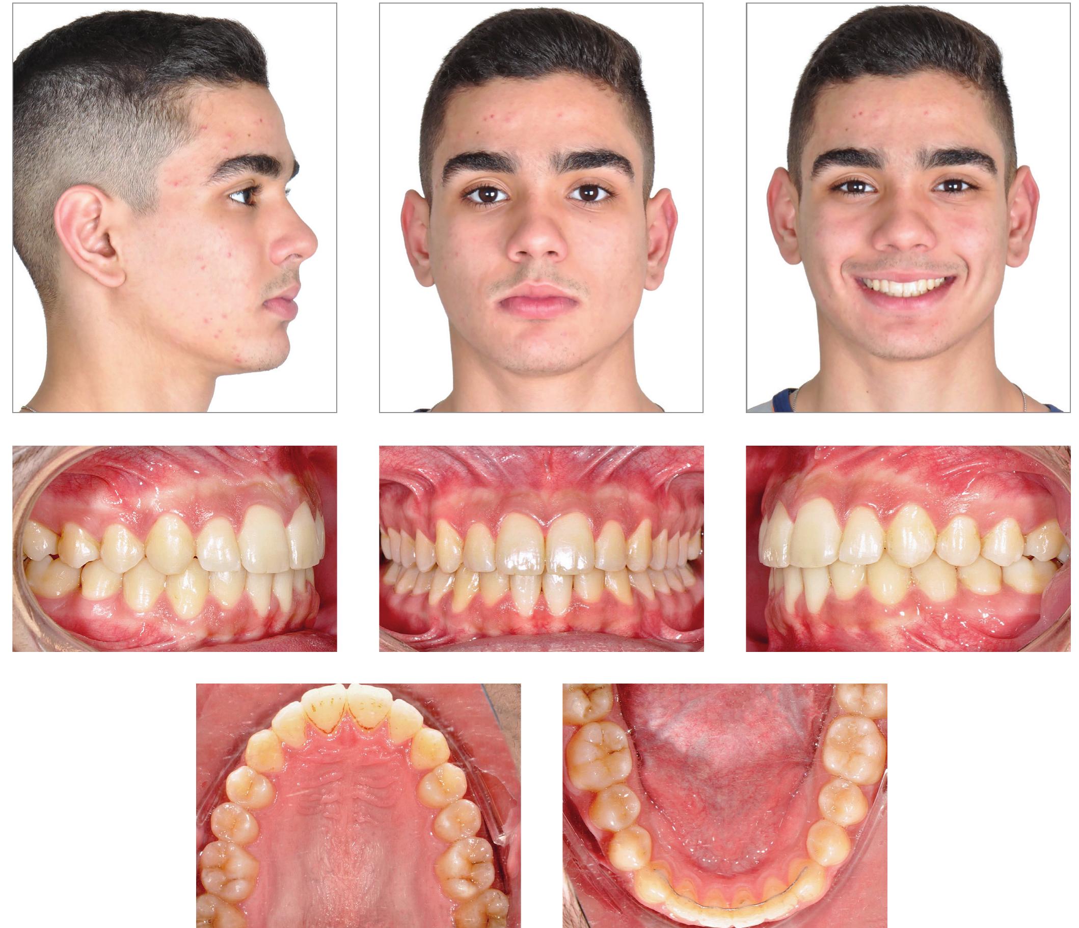 (PDF) Superimposition of 3D maxillary digital models using open-source ...