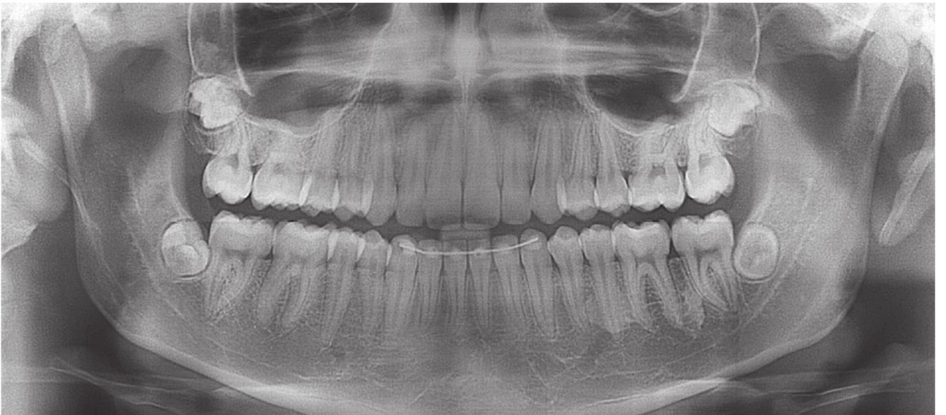 (PDF) Superimposition of 3D maxillary digital models using open-source ...