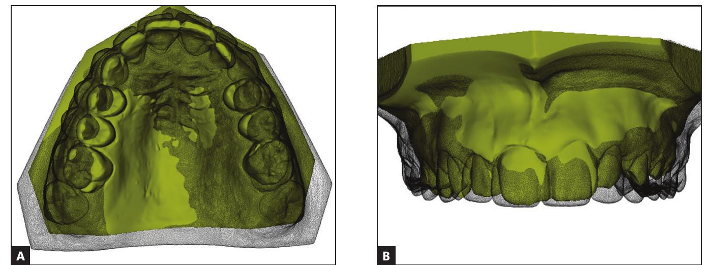 (PDF) Superimposition of 3D maxillary digital models using open-source ...