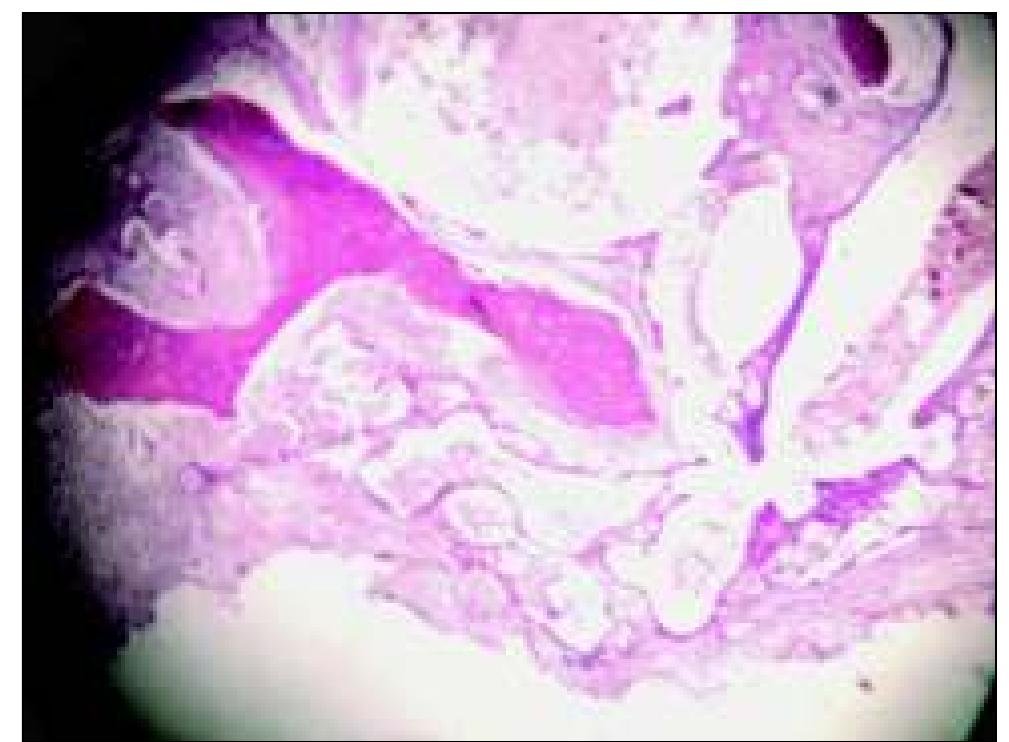 Table 1 - Central Haemangioma (Intraosseous) of Jaw